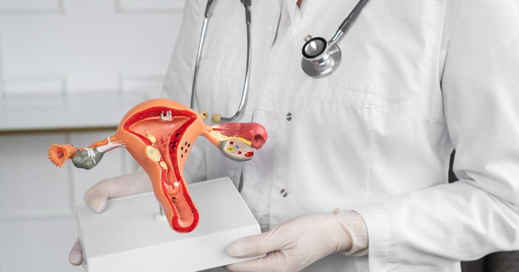 Como a endometriose afeta a fertilidade e opções de tratamento