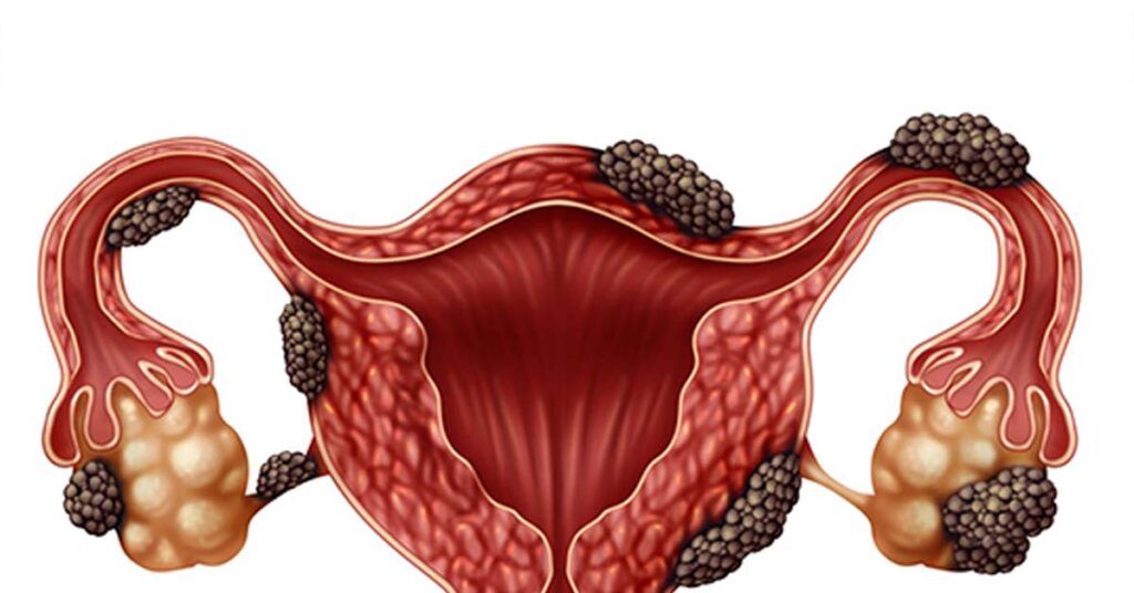 Mitos comuns sobre Endometriose desmistificados